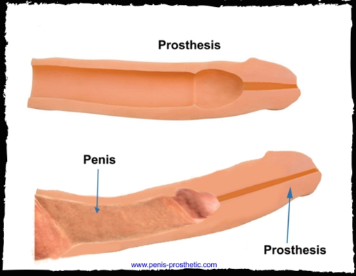 realistic penis prosthetic
